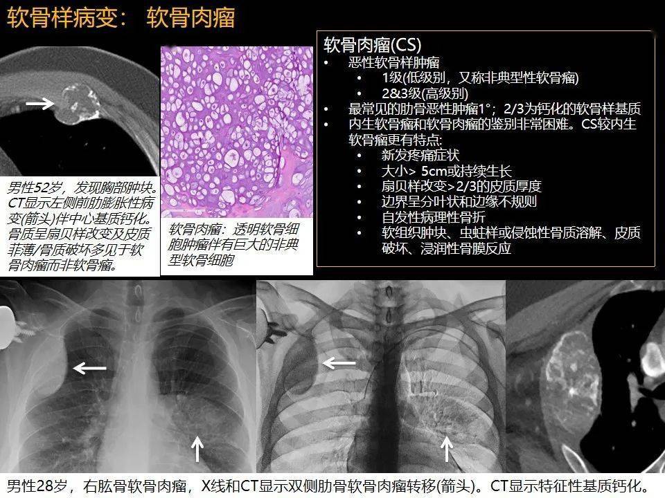 rsna精选内容肋骨肿瘤肿瘤样病变及获得性非创伤性病变的影像诊断基本