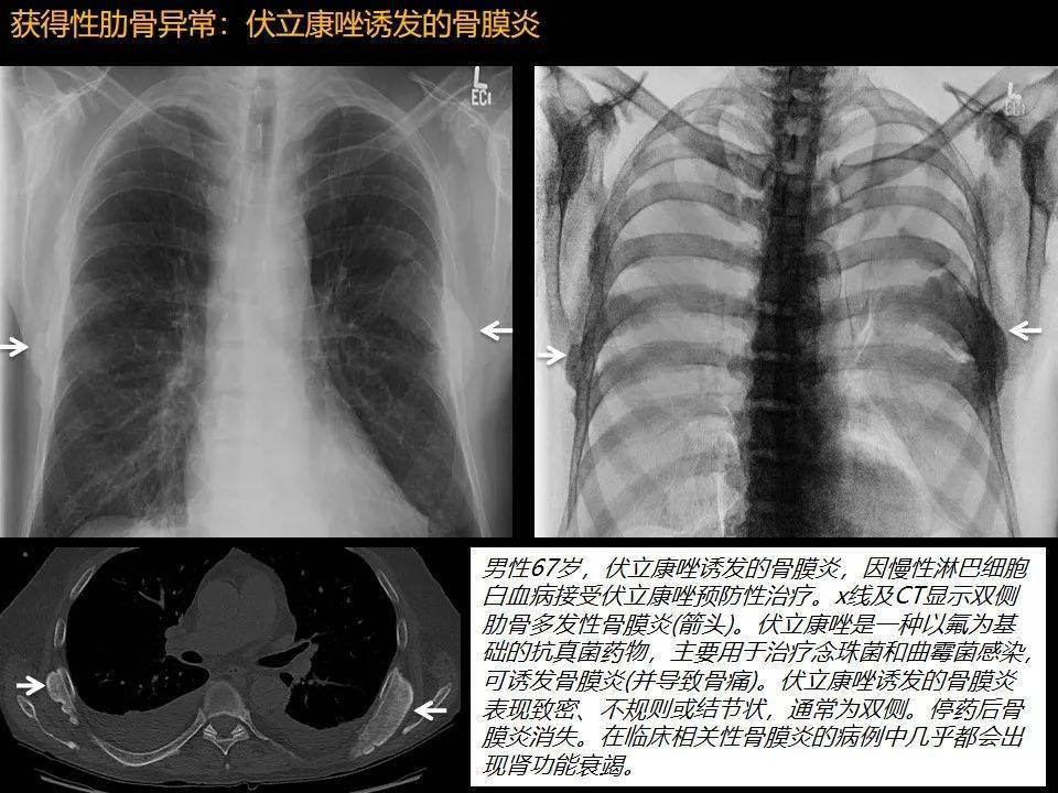 肋骨肿瘤恶性的图片图片