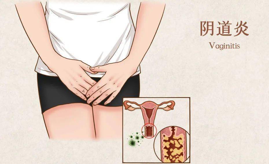 女性尿道感染几天图片