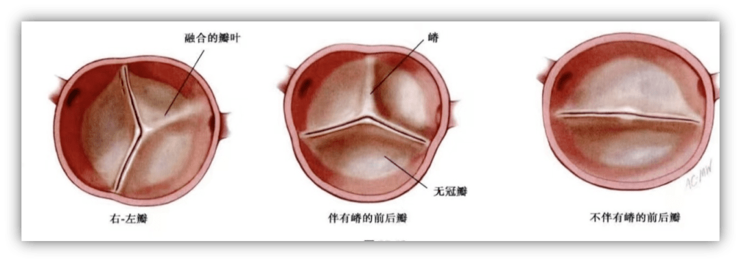 二叶主动脉瓣是临床上最常见的心脏畸形,属于先天性心脏病的一种,发病