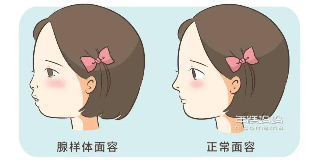 现在女儿腺样体肥大 3-4 度,绝不能让孩子再吃这种亏.