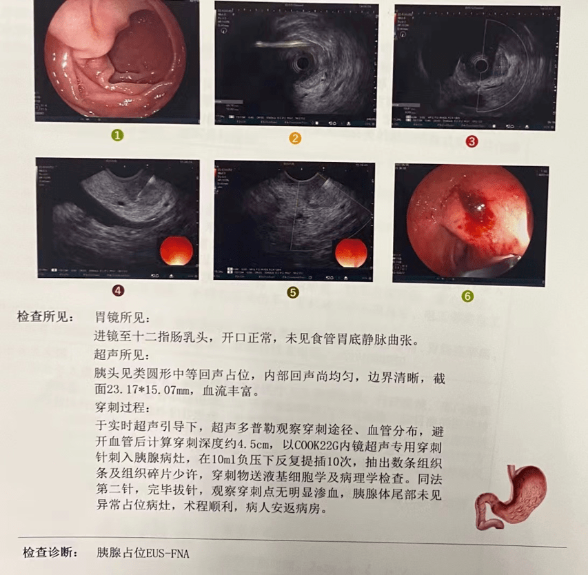 超聲內鏡(eus)細針穿刺活檢(fna):ercp檢查:腹部ct:胰頭部富血供佔位