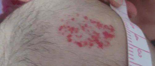 血管瘤怎么办?正确应对,告别面对血管瘤的不知所措_治疗_家长_医生