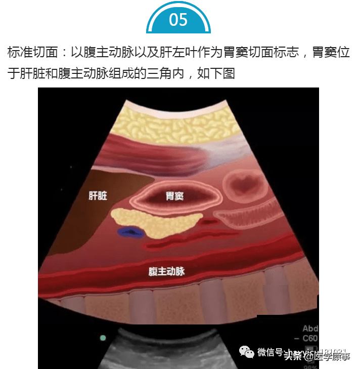 重症超声床边获得胃窦超声切面