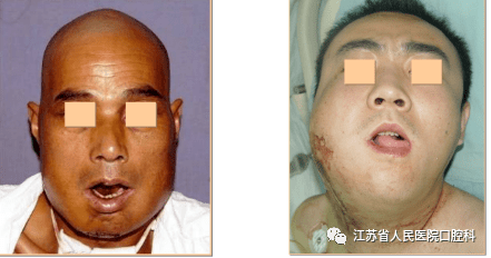 及早清除口,鼻腔及咽喉部异物2.将后坠的舌牵出3.