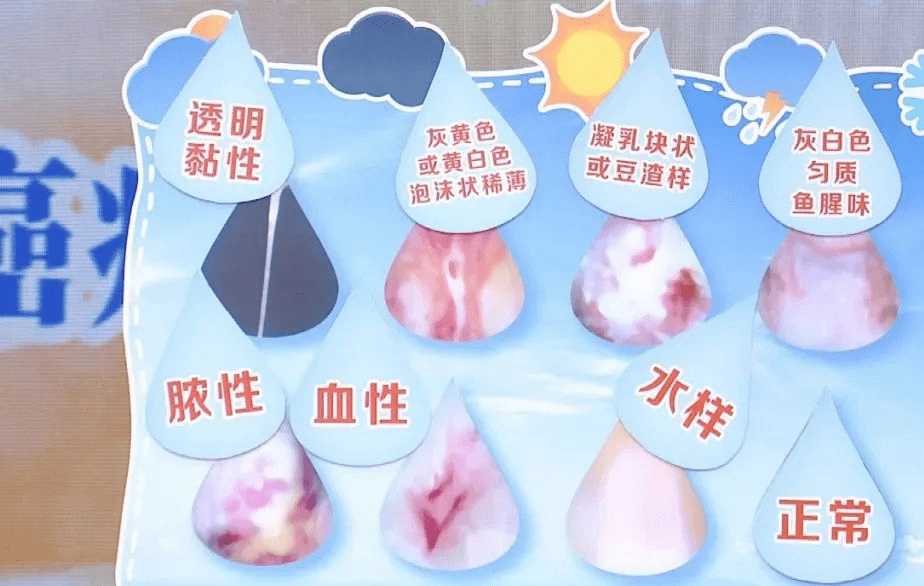 滴虫性阴道炎是由阴道毛滴虫引起的.