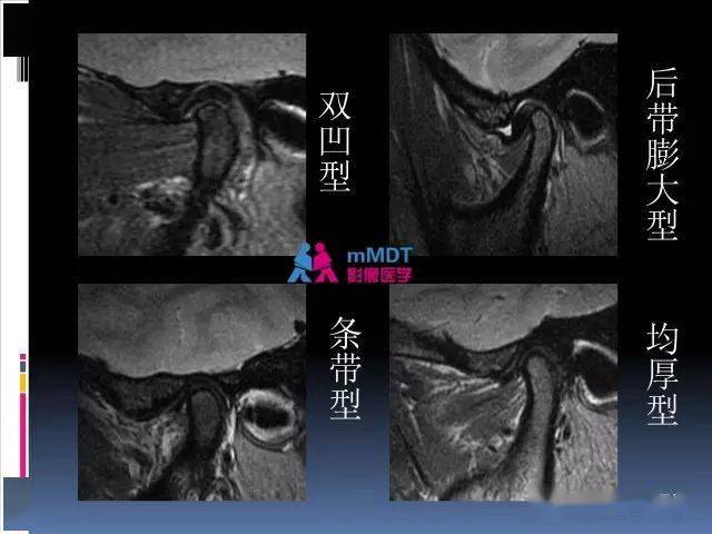 颞下颌关节的磁共振成像(检查技术与解剖部分)_影像_张静坤_腹股沟