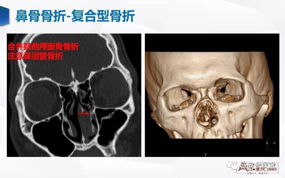 鼻骨正常ct解剖变异与骨折