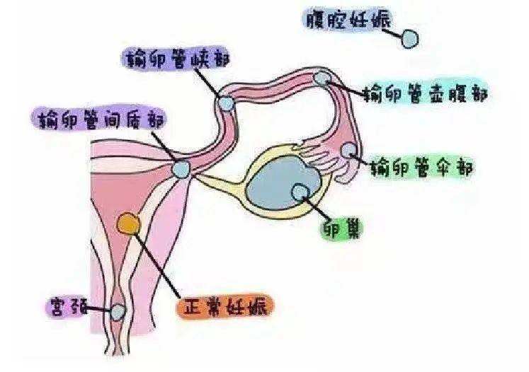 产妇子宫破裂大出血多学科合作快速确诊紧急抢救