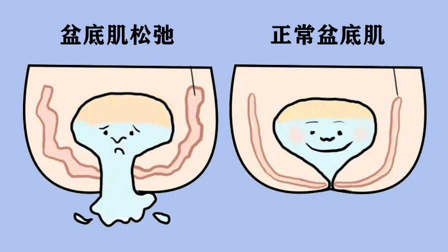 女性尿失禁 请来这个科室瞧瞧_康复_盆底_治疗