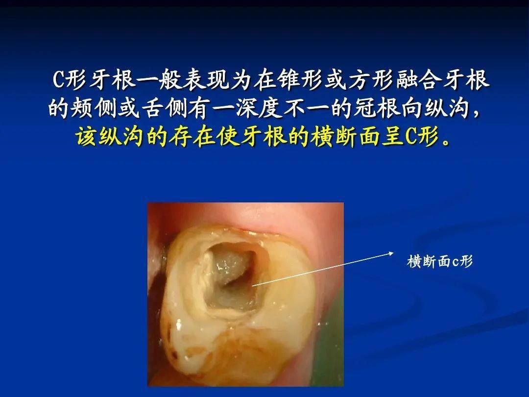 c型根管的特点及解析