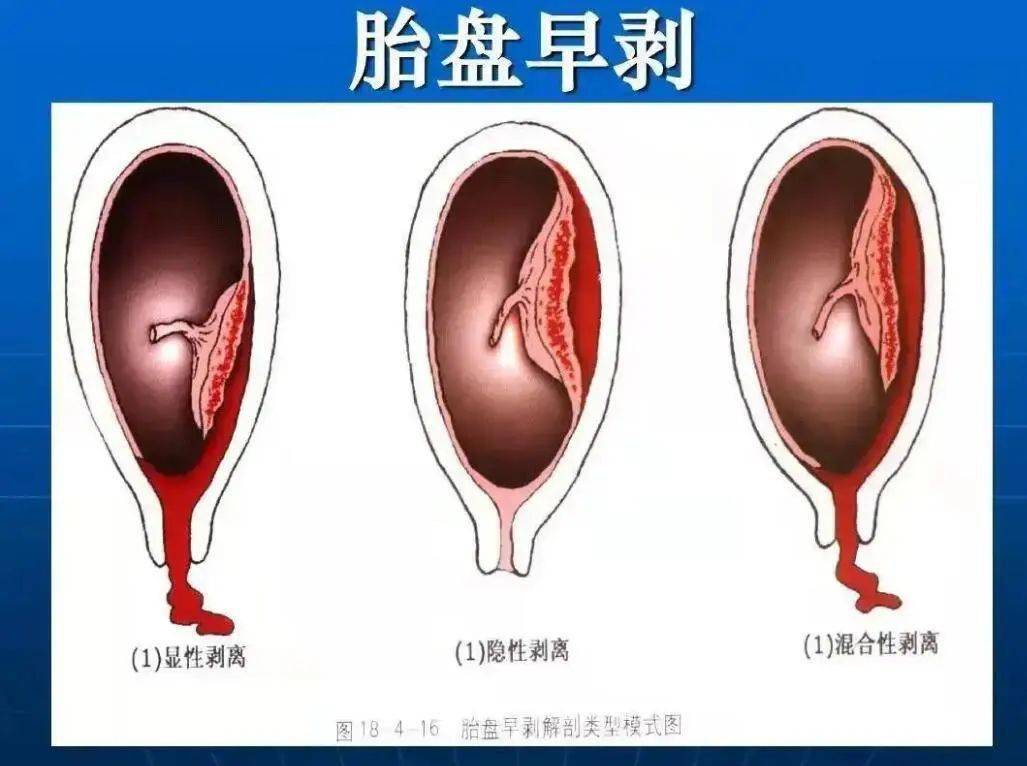 前置胎盘胎盘早剥图片