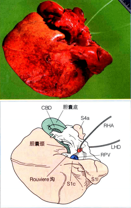 肝脏面的h形沟图片图片