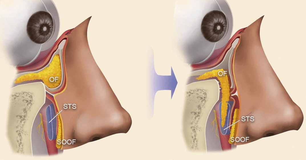 【健康】"内吸眼袋"是什么高科技?可别被忽悠了_美容_王江允_郑州