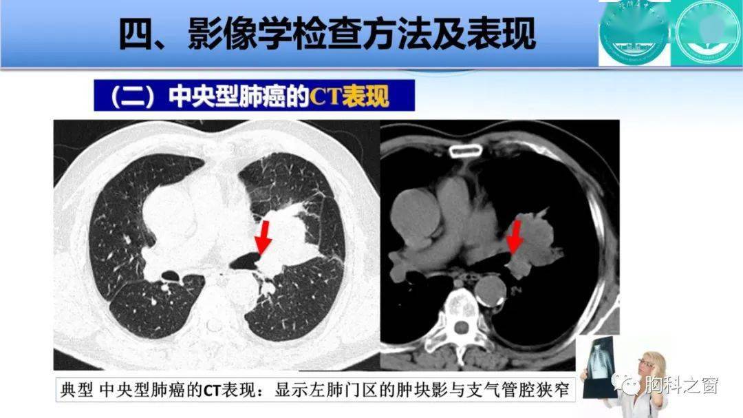 中央型肺癌ct图片