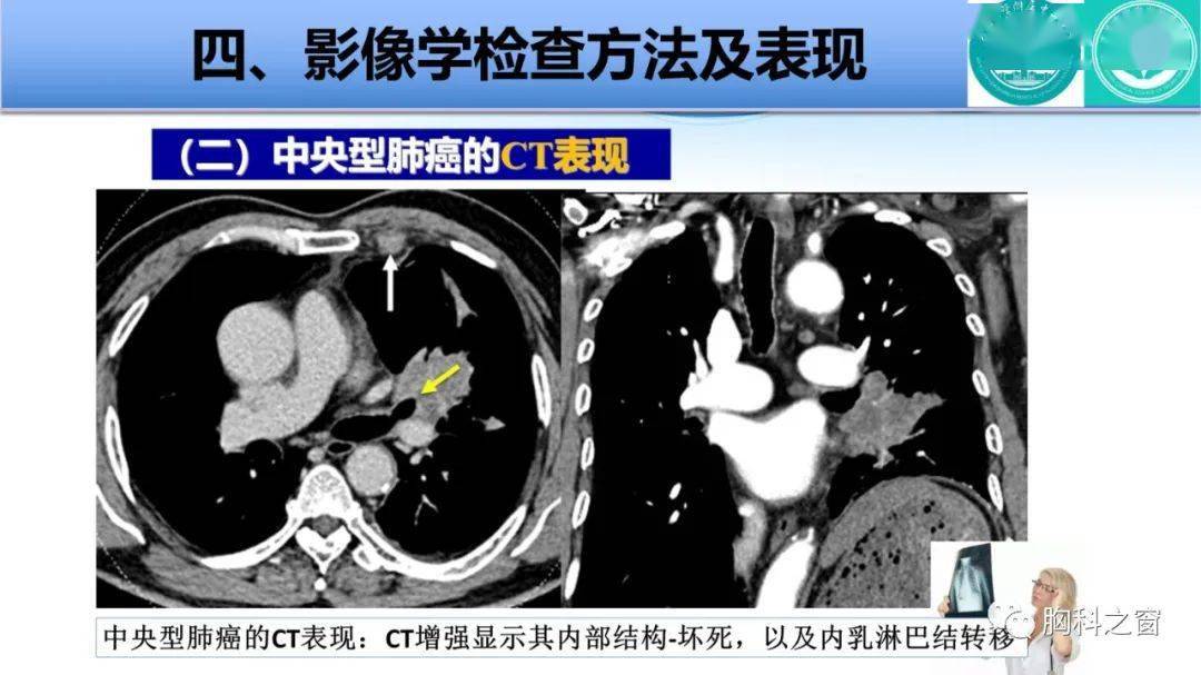 中央型肺癌的影像学表现及相关疾病鉴别诊断