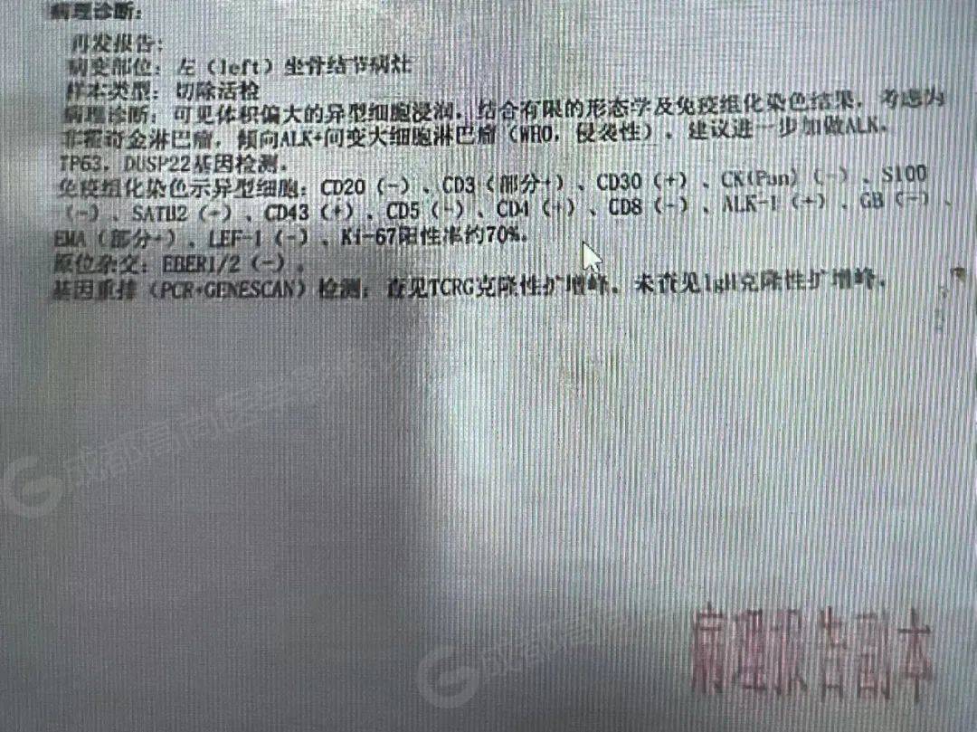 间变性大细胞淋巴瘤病例分享