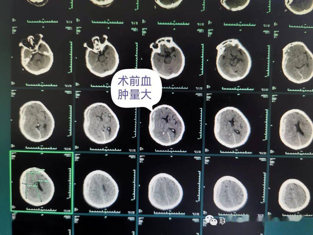 患者硬膜下血腫量大,約100ml左右,中線移位明顯,已經昏迷,但常規的骨