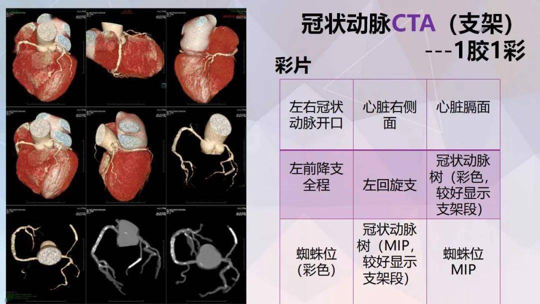 冠脉及胸痛三联cta重建规范及报告模板