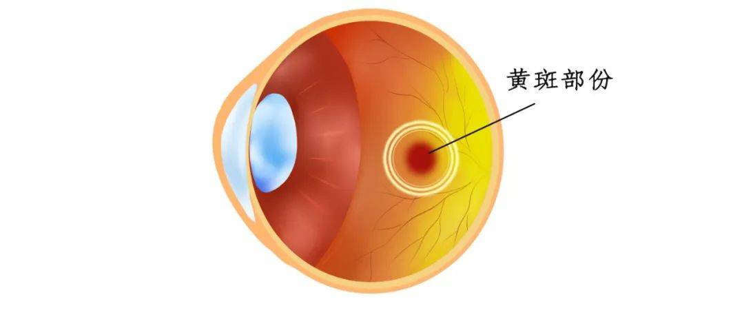 研究发现：一种新的黄斑疾病，由多个基因突变导致了视力丧失_个体_相关_家族
