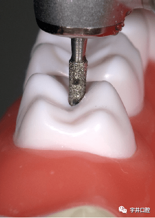 选择固美,成就牙之美—固美规范化瓷嵌体预备车针_定深_备牙_临床
