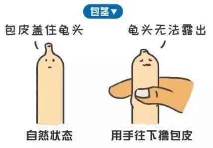 长,包皮内长期存留包皮垢,反复刺激可以引起丁丁头发炎(即龟头包皮炎)