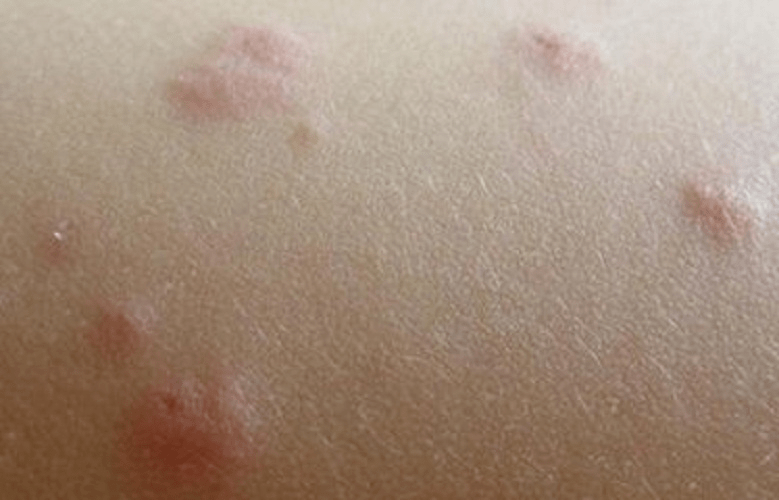 过敏性荨麻疹诊断证明图片