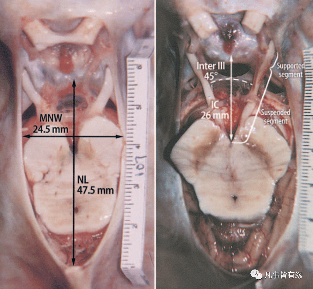 小脑幕切迹疝解剖图图片