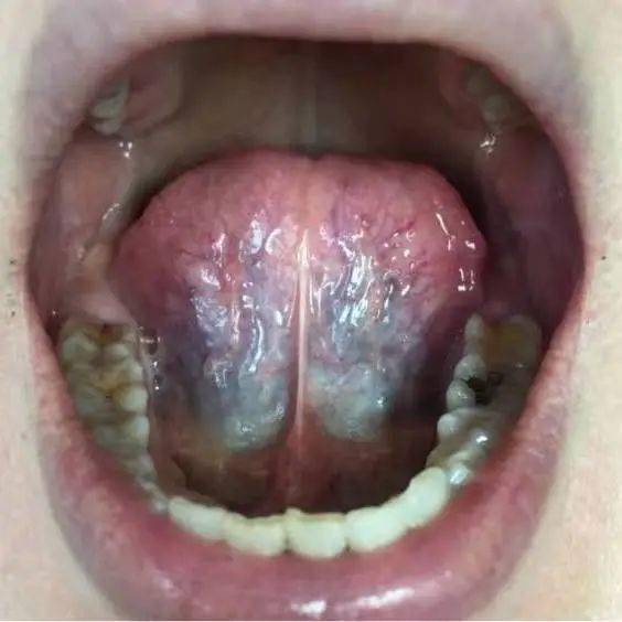 张开嘴,舌尖舔上嘴唇的时候,我们会看到舌下有两条静脉