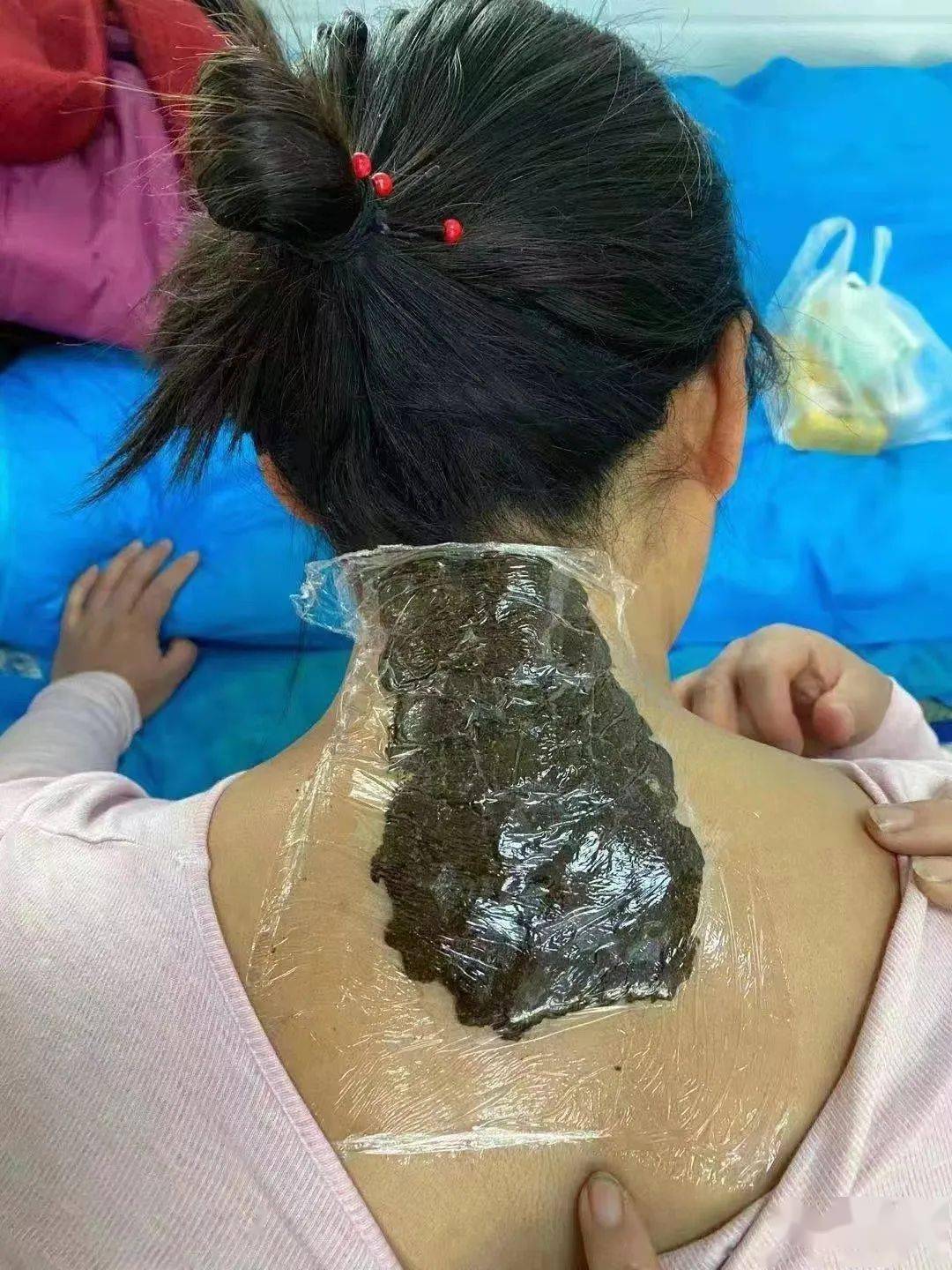 最佳三伏贴