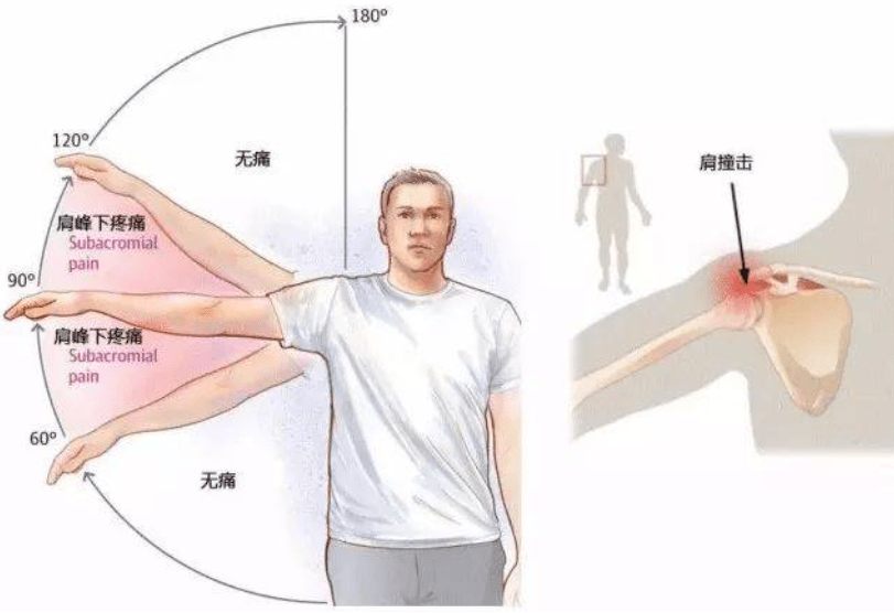1)搭肩试验