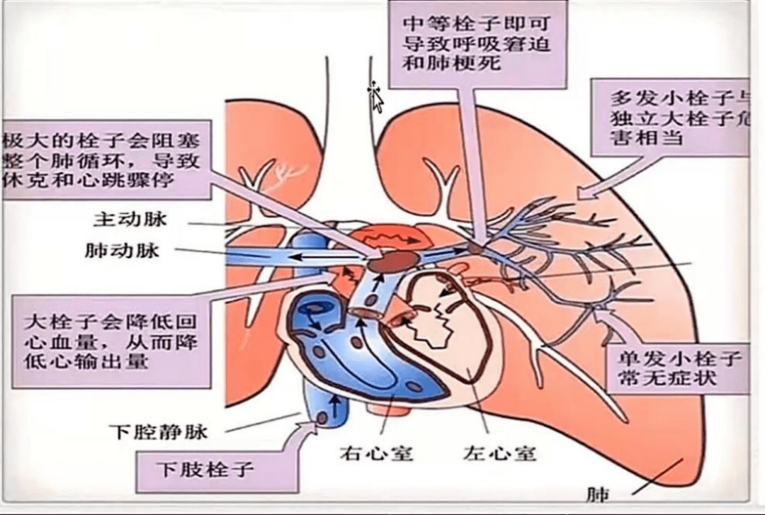 肺栓塞图片 示意图图片