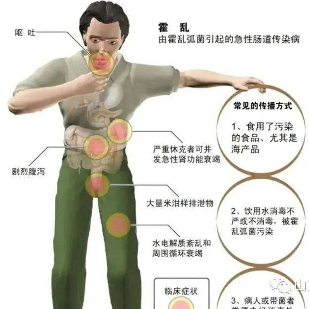 【健康科普】关于霍乱,您了解多少?_Vibrio_脱水_症状