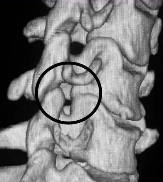 颈椎的钩椎关节位置图图片