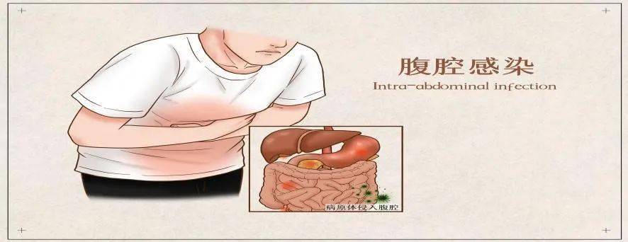 检查后发现存在疾病复发的情况,并出现了不完全性肠梗阻伴腹腔感染