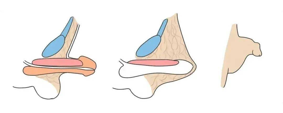 隐匿阴茎是指阴茎海绵体发育基本正常,由于阴茎筋膜在发育过程中呈