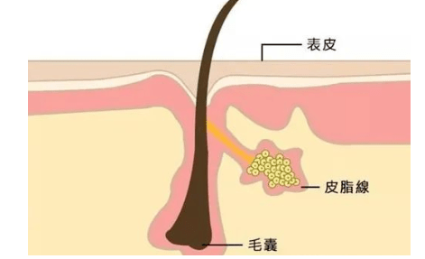 外用维a酸乳膏,具有改善毛囊皮脂腺导管角化,溶解微粉刺及粉刺,抗炎