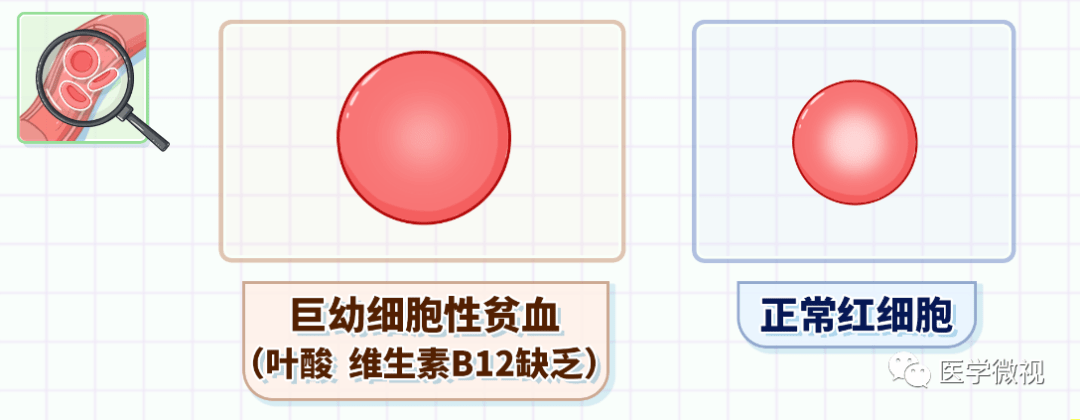 常見於缺乏葉酸,維生素b12引起的巨幼細胞性貧血;根據以上三項的變化