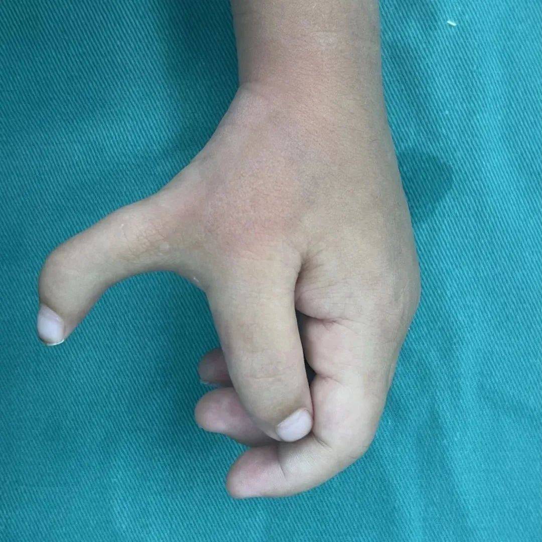 上下互换，弥补遗憾！|拇指|手指|外科|畸形|患者|手术|再造|-健康界