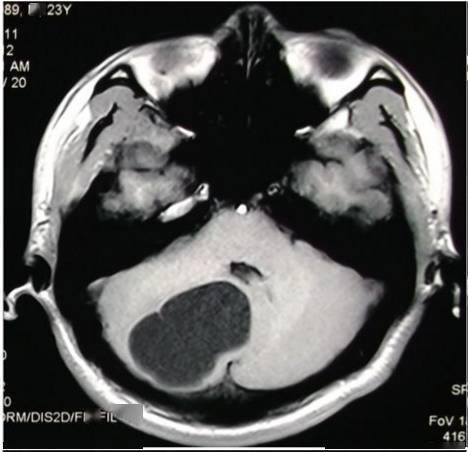 小脑囊肿图片