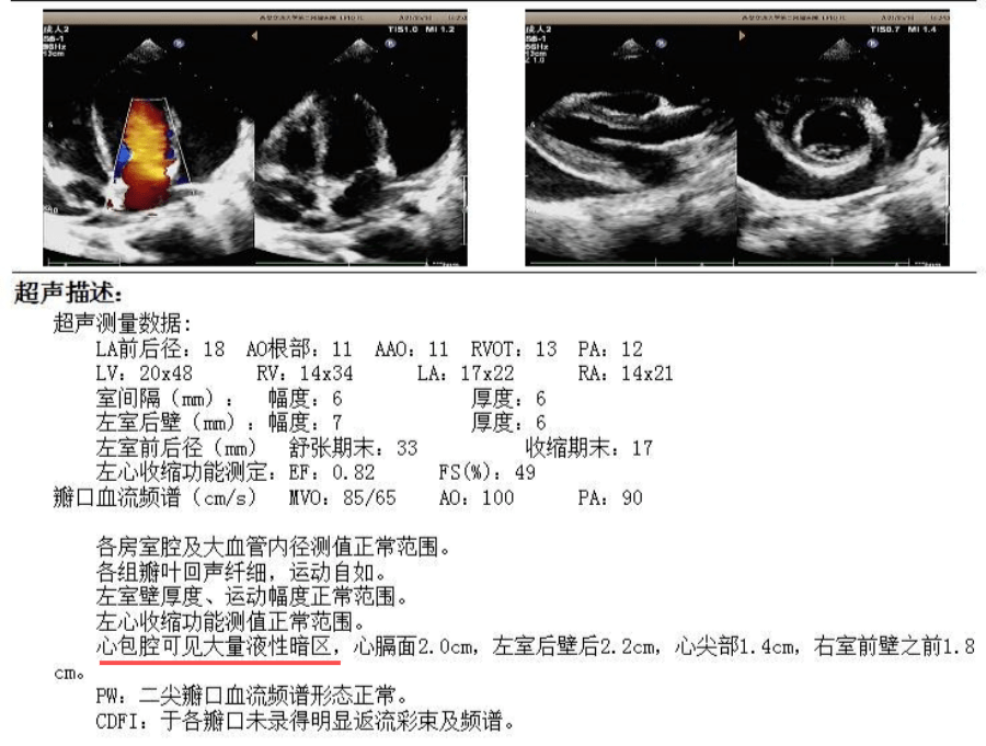 超声胸水腹水鉴别图图片