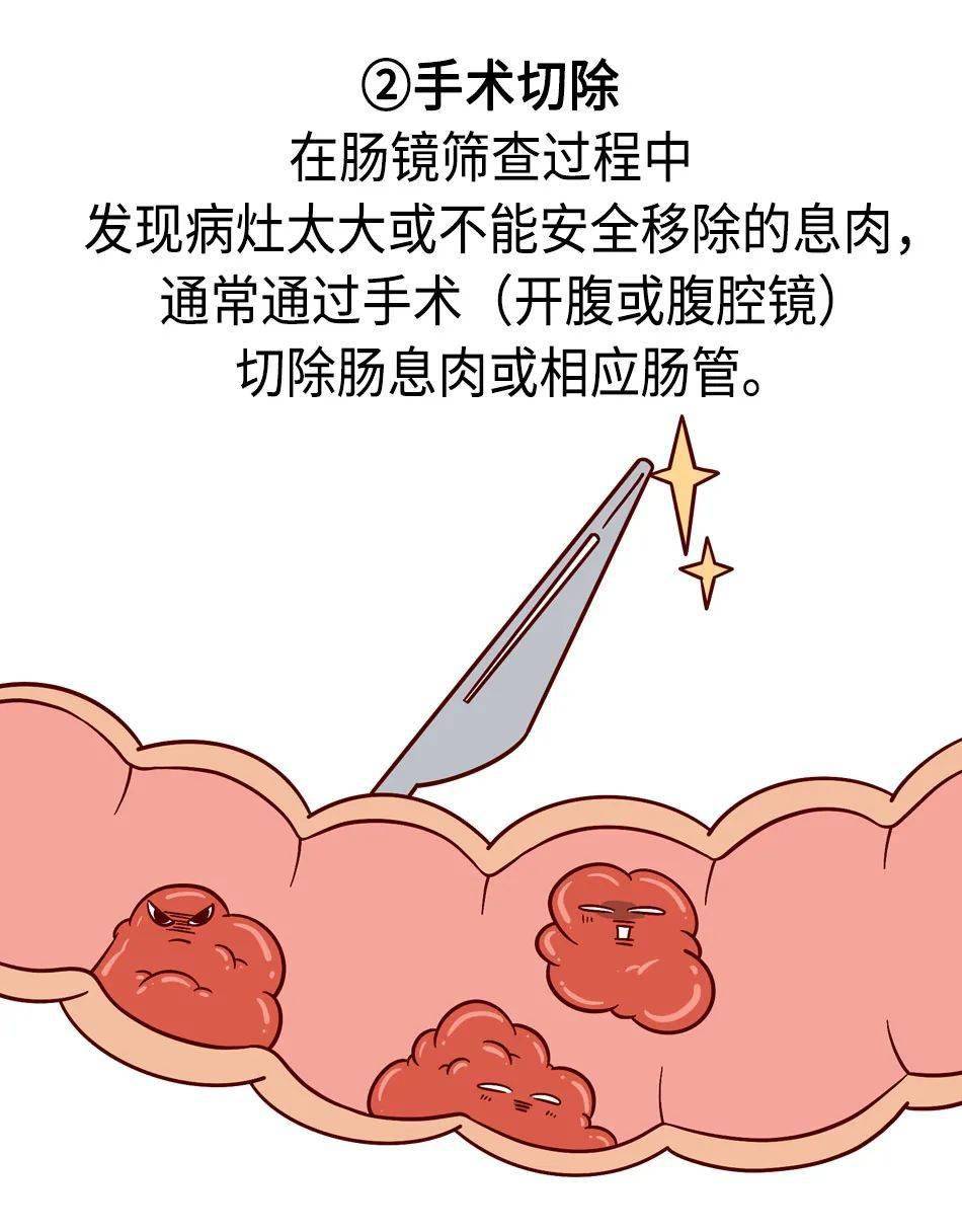 肠息肉卡通图片