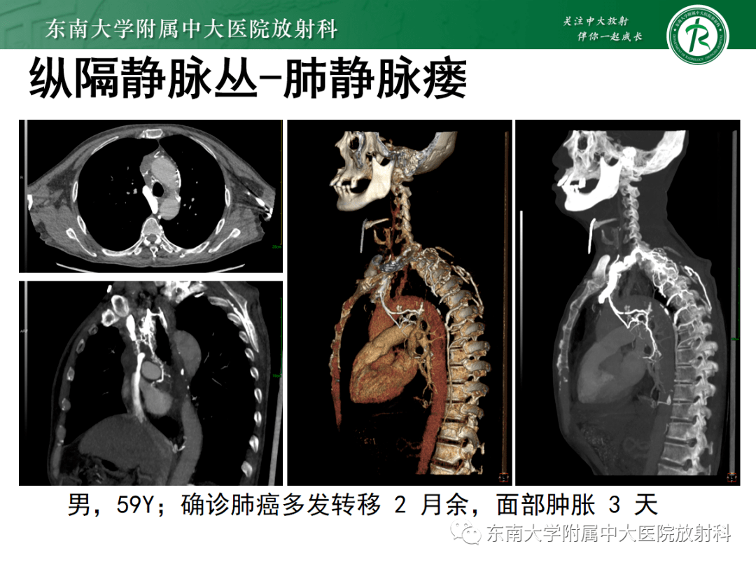 上腔静脉解剖图ct图片