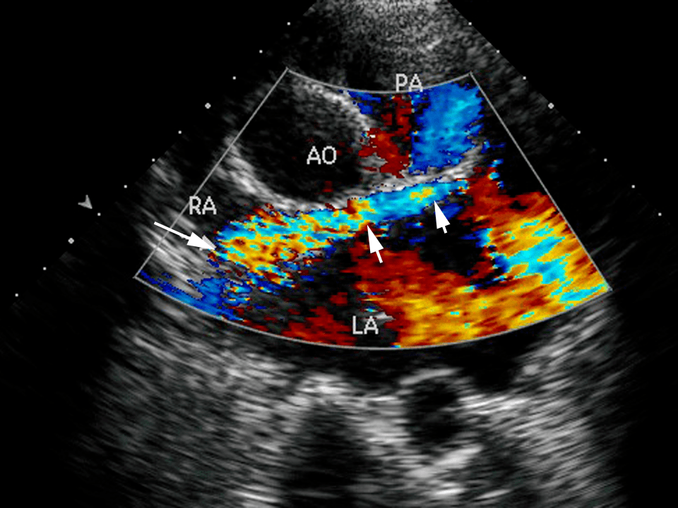 一文掌握:超声心动图必备基本功_诊断_多普勒_胸骨