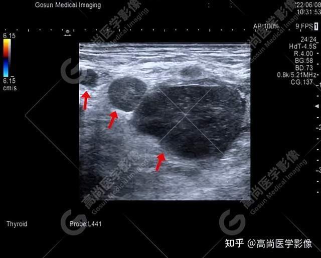 超声肝脏转移癌—胃肠,没事吗?_检查_淋巴结_诊断