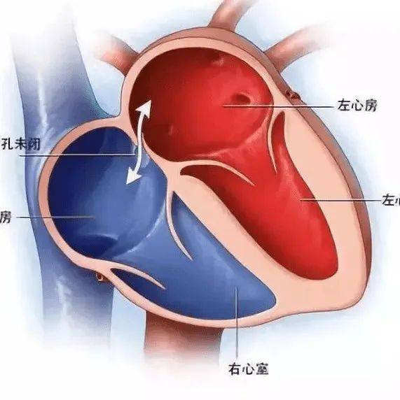 【聚焦临床】34岁女子急性脑梗死，只因为心脏多了个“眼”？ 王女士 患者 检查