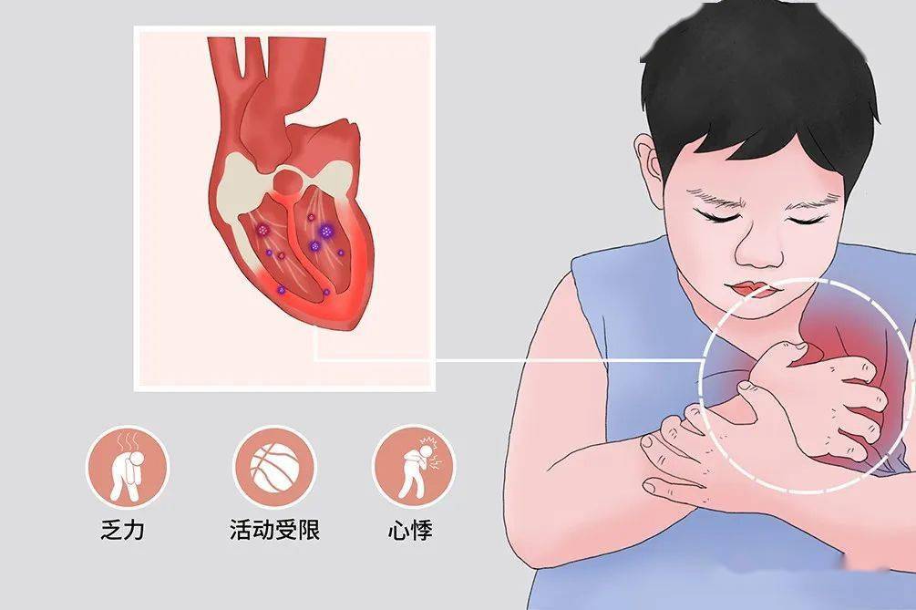 心肌炎早期有8症状图片