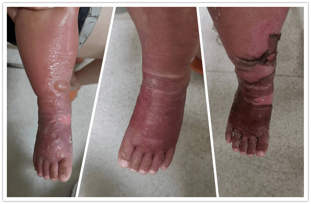 误信偏方,皮肤出现红肿,水疱 青岛妇女儿童医院专家提