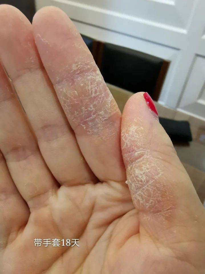 0用药,只做这件事,就缓解多年顽固手湿疹!_手部_手套_治疗