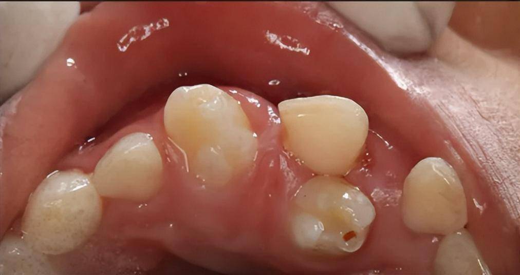 人类的牙弓也越来越小,这样导致很多人的牙齿拥挤错位,影响美观